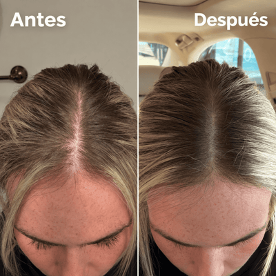 VALENITA™| Sérum Capilar PDRN con Microagujas